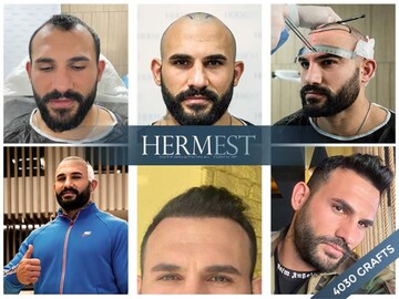 Best top 11 hair transplant clinics in Turkey: Everything you need to know