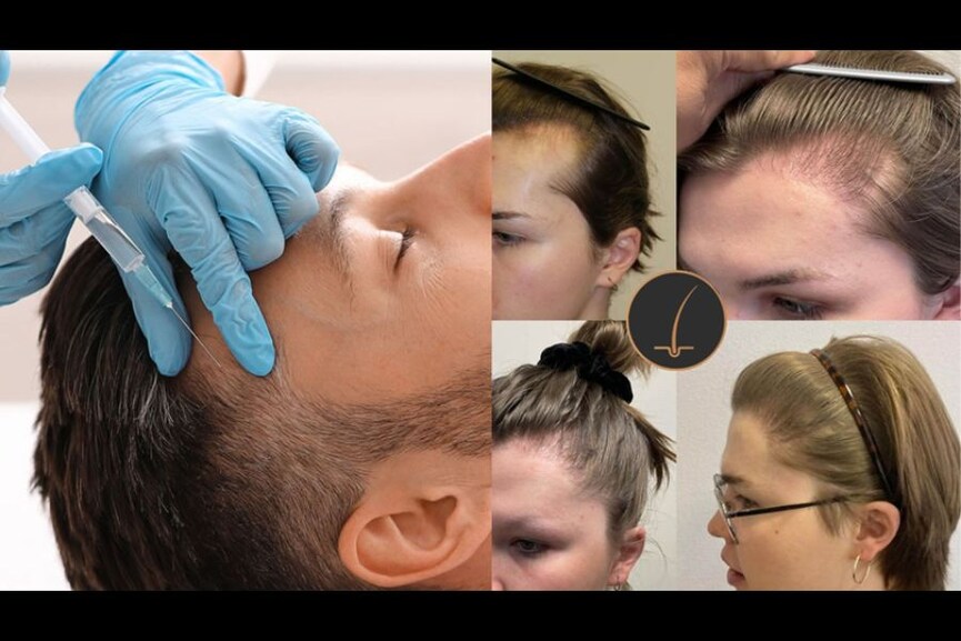 Hair transplant in UK, how to choose the best option?