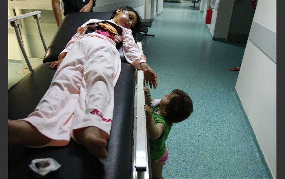 Shams al-Mohamad, a 6-year-old Syrian girl, lies on a stretcher as she looks at her sister Marwa at 