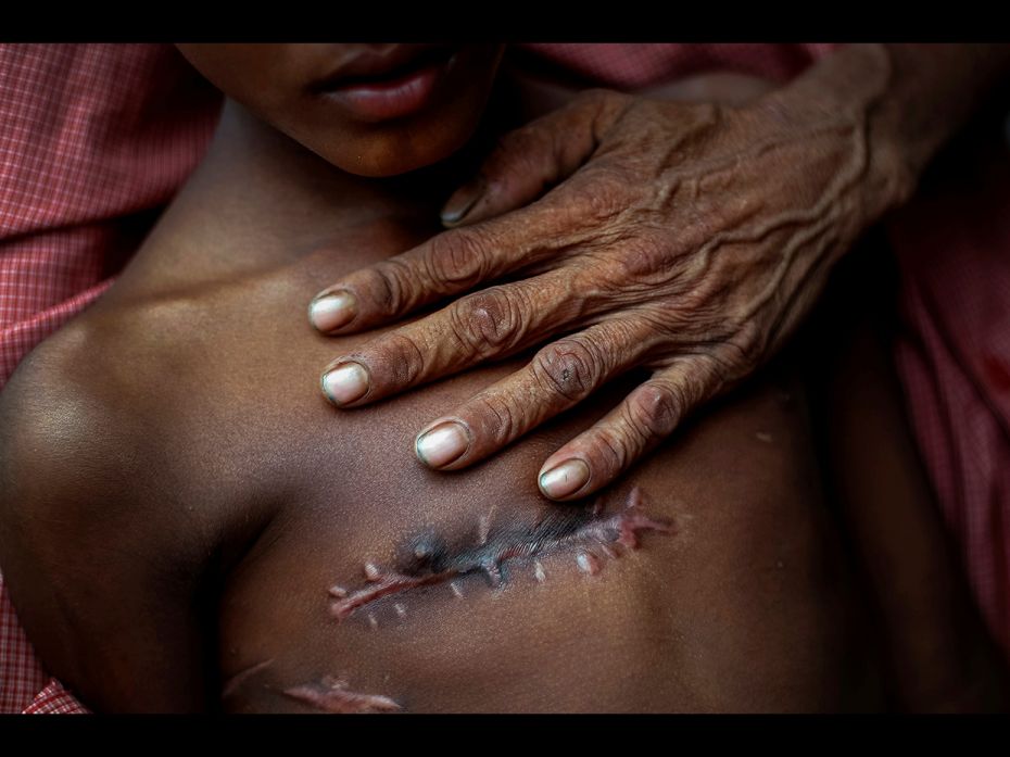 Mohammed Shoaib, 7, who was shot in his chest before crossing the border from Myanmar in August, is 