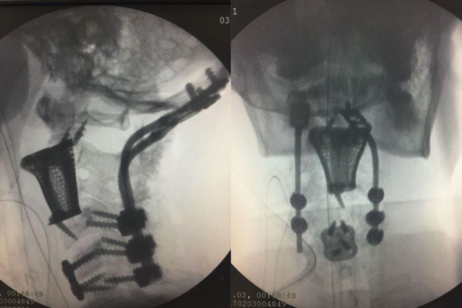 A team of surgeons from Medanta: The Medicity, Gurugram, last year successfully implanted a 3D-print