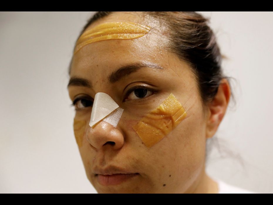 The marks of goggles and plasters are seen on a nurse's face after her shift inside the intensive ca